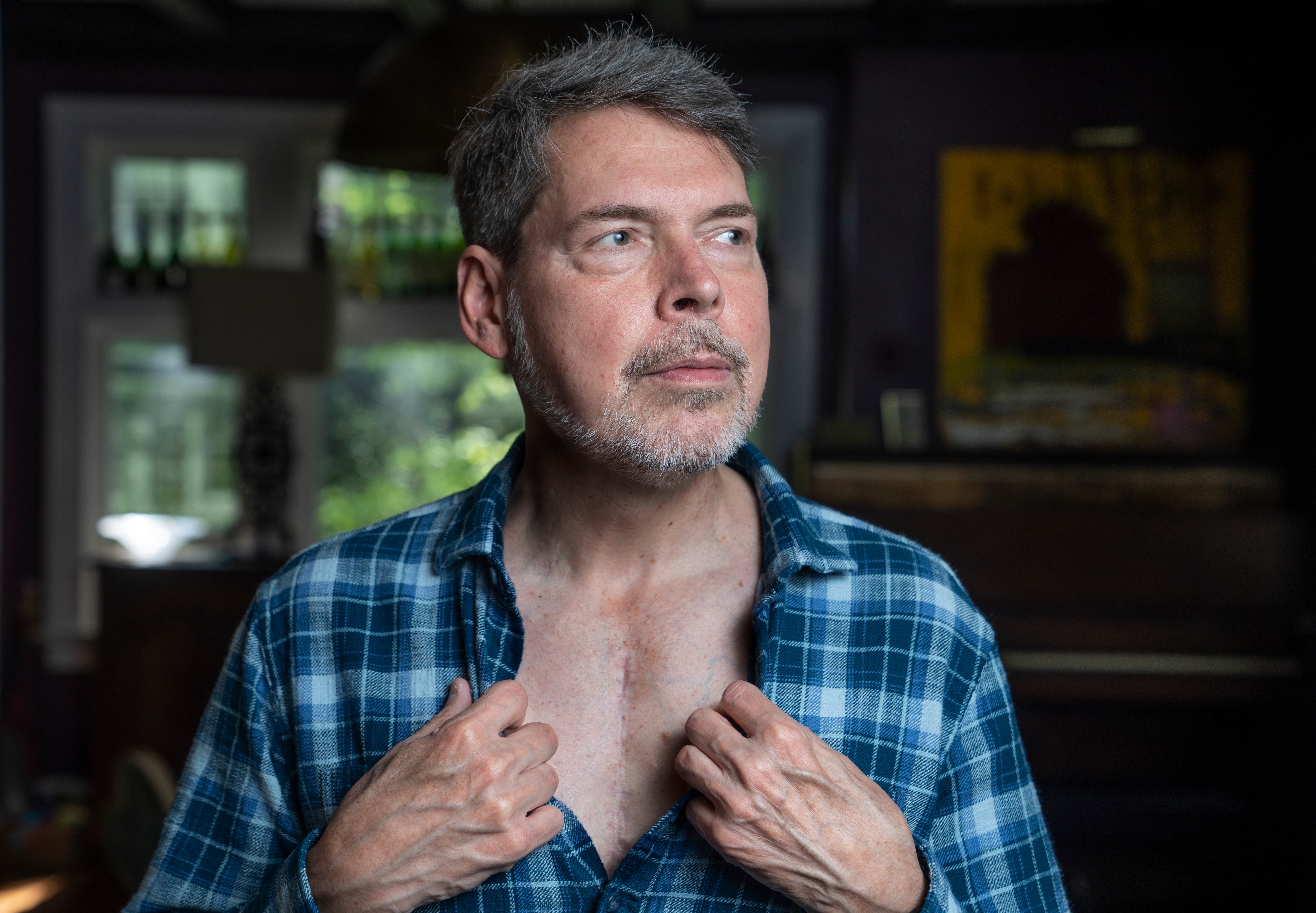Restaurateur Tony Foreman shows the scars on his chest from numerous surgeries.