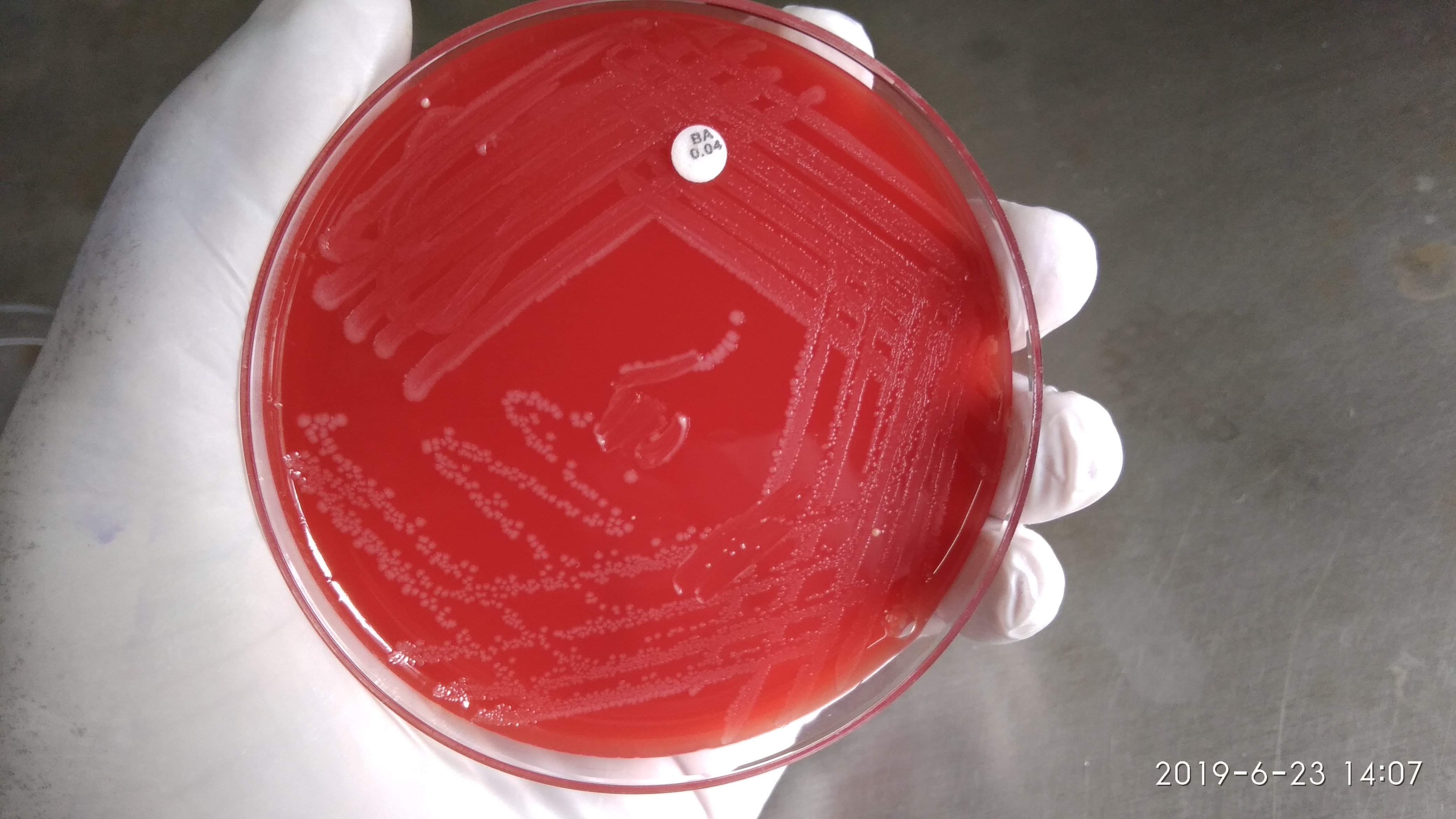 Maryland has the second highest number of cases of Listeria, a bacterial infection that can cause flu-like symptoms, the Centers for Disease Control and Prevention reported Friday.