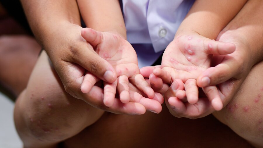 Hand, foot and mouth disease is yucky but rarely dangerous