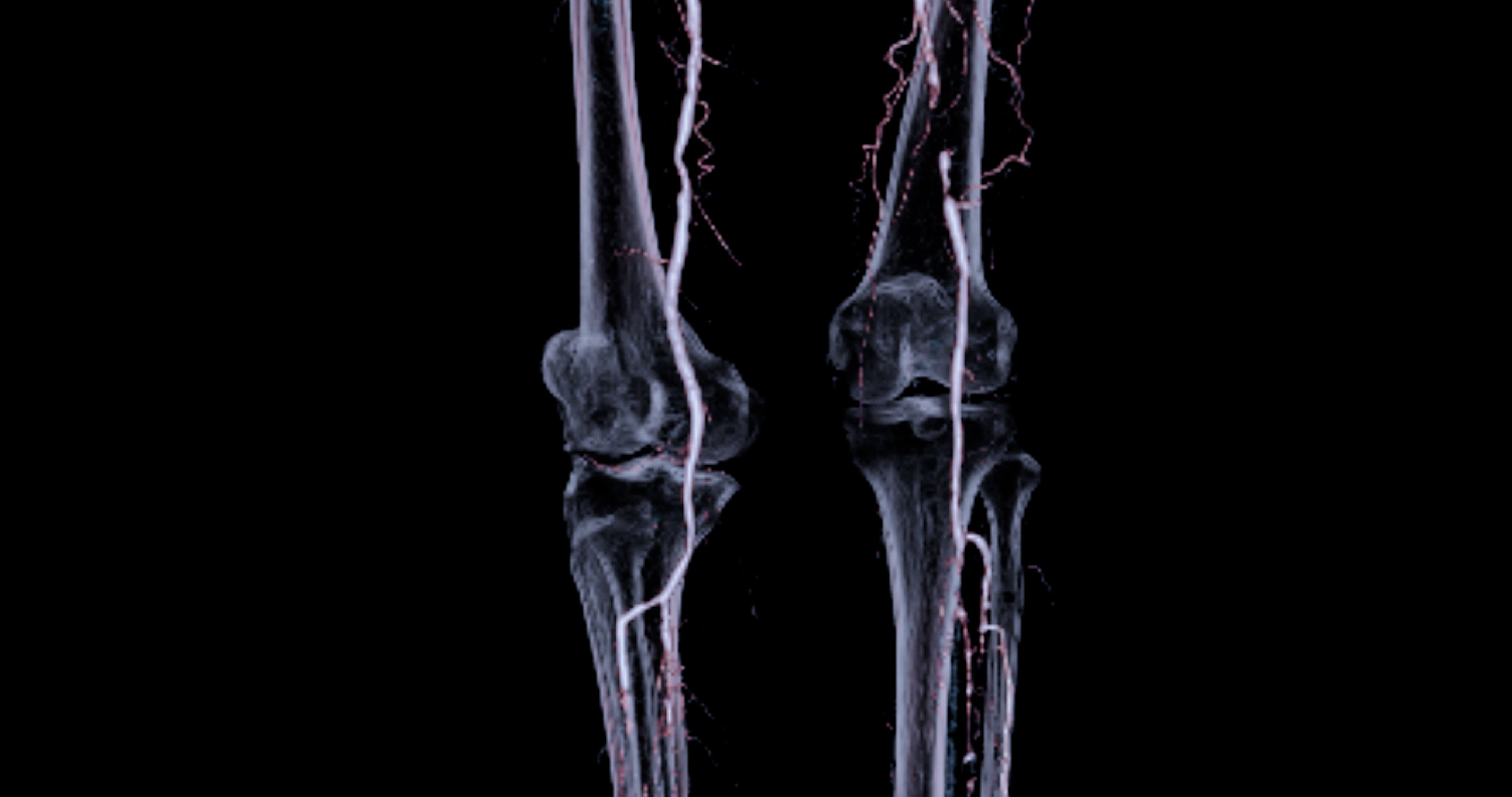 CTA femoral artery run off image of femoral artery for diagnostic Acute or Chronic Peripheral Arterial Disease.