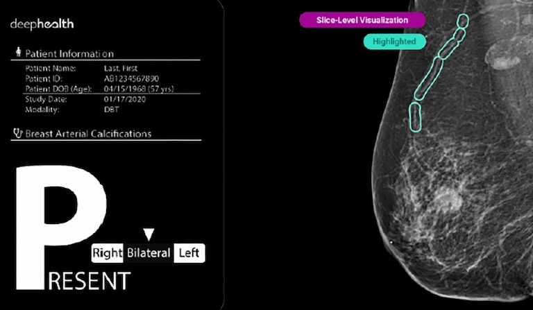 A new law in Maryland requires imaging centers to alert patients to certain calcium deposits linked to heart disease that show up in mammograms as little white lines.
