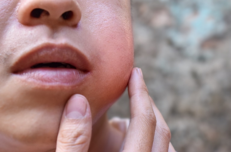 Mumps cases in Maryland jump to 26 this year, more than six times the 2025 total.