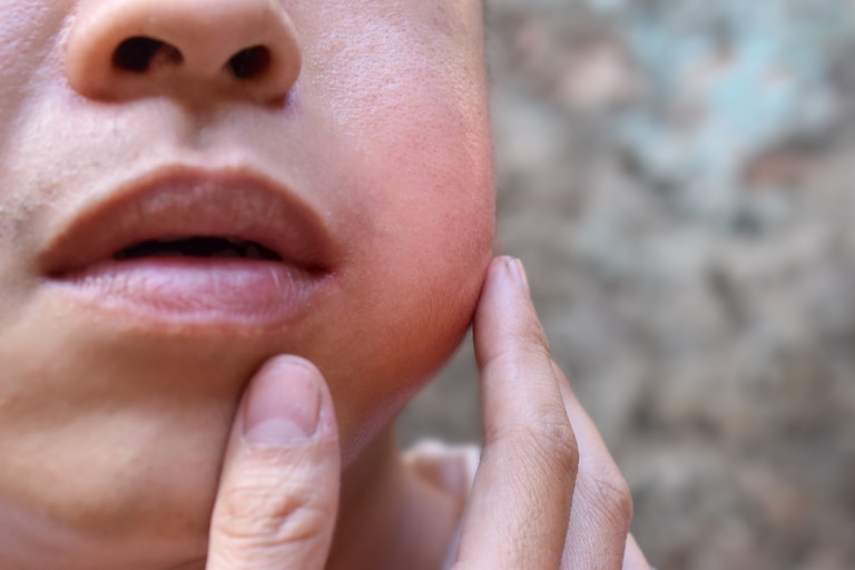 Mumps cases in Maryland jump to 26 this year, more than six times the 2025 total.