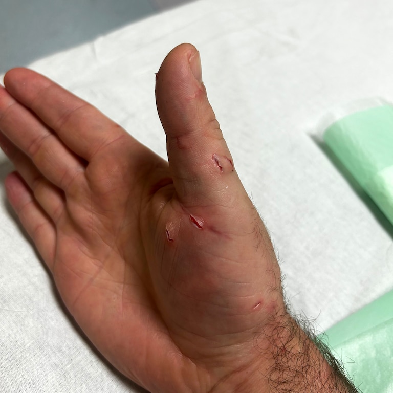 Brendan Oster sustained several lacerations to his hand after being bitten by a shark on Sunday at Assateague State Park.