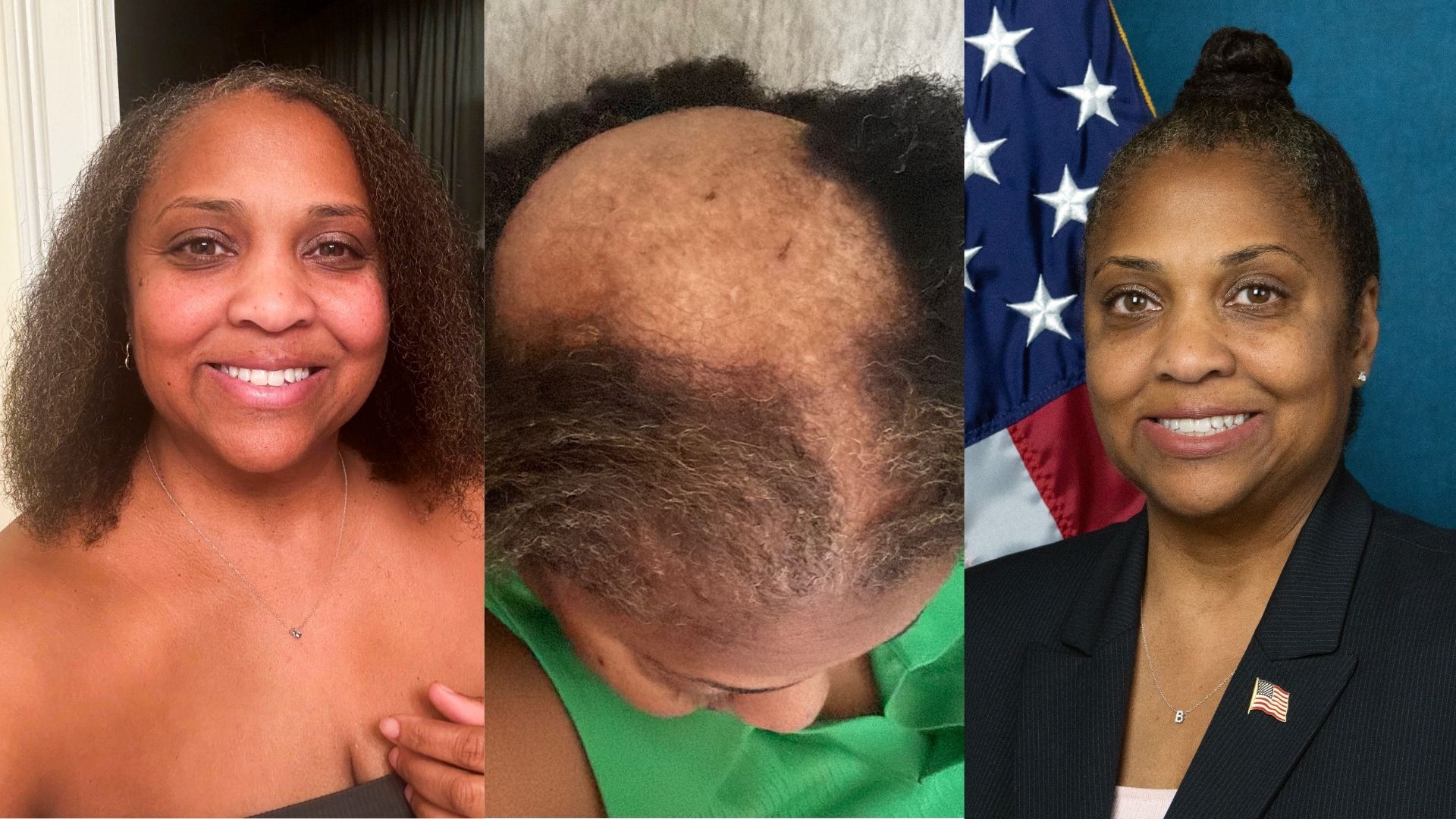 Belinda Robinson participated in a Johns Hopkins Medicine study to see if a common diabetes drug could help her regrow hair after she was diagnosed with alopecia.